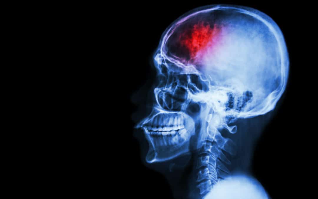 The Silent Epidemic—Traumatic Brain Injury (TBI) In Louisiana